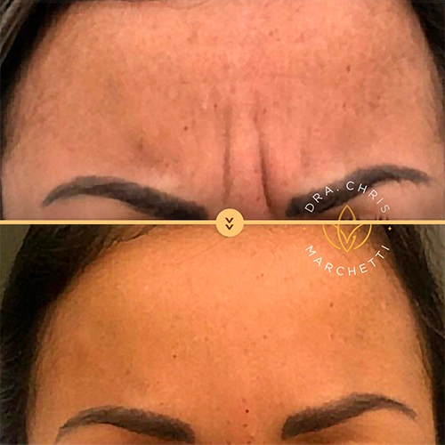 Botox antes e depois