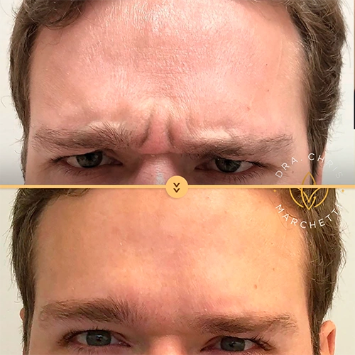 Antes/depois botox