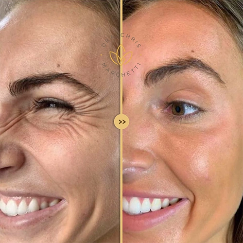 Antes e depois botox