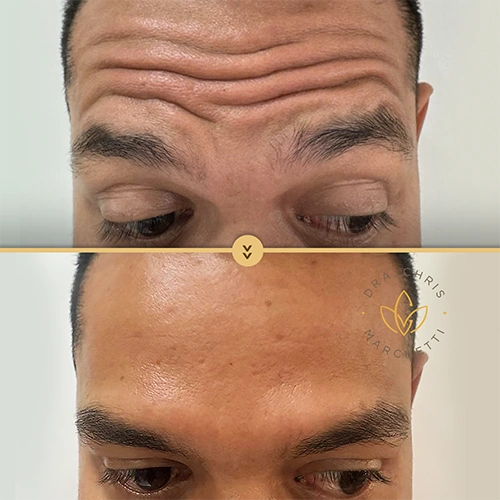 Antes e depois da aplicação de botox
