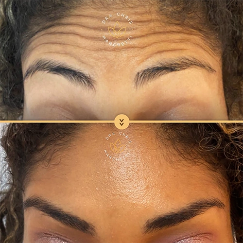 Antes e depois do botox