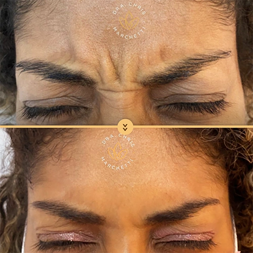 Antes depois botox