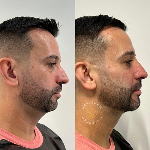 harmonização facial homens