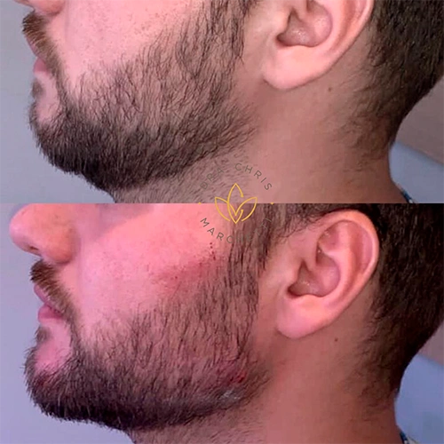 harmonização facial masculina