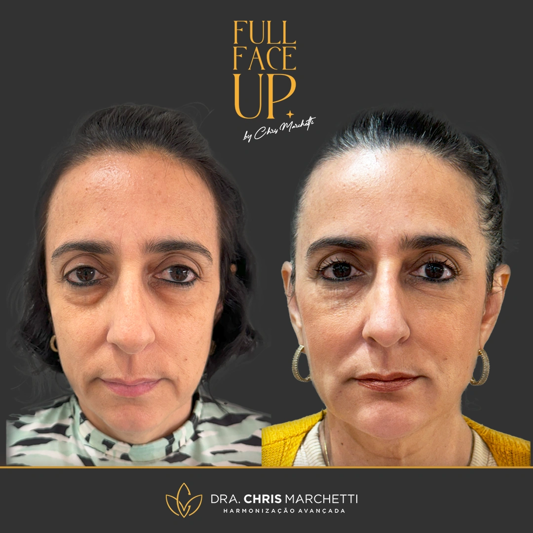 harmonização facial