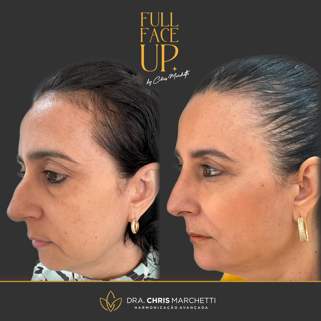 harmonização facial