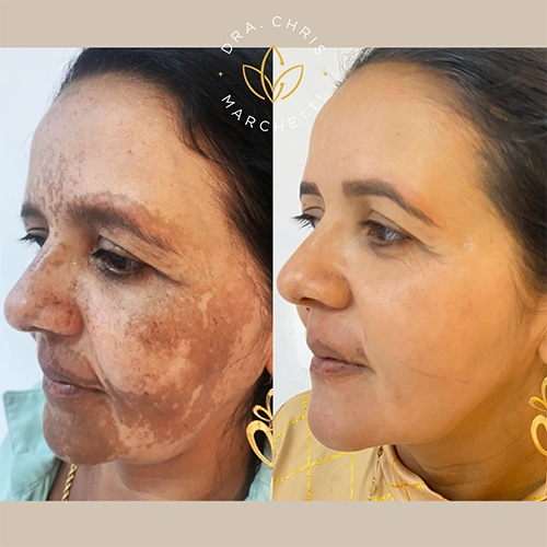 Antes e depois melasma