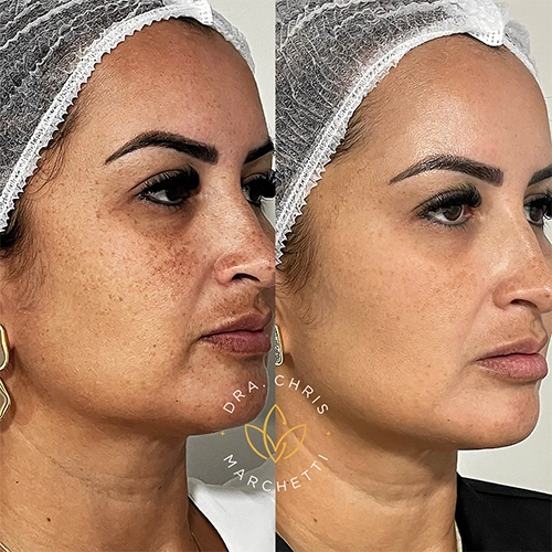 Antes e depois tratamento melasma