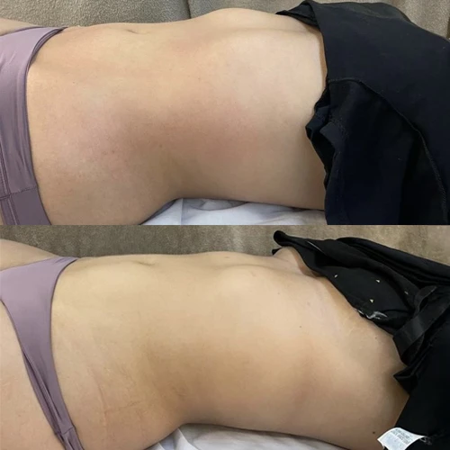 Antes e depois Slim Lipodetox® 1