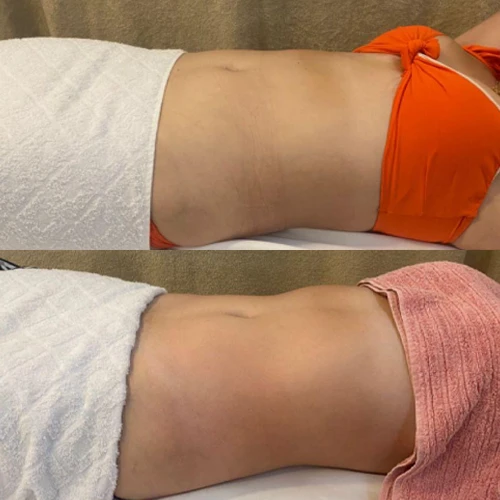 Antes e depois Slim Lipodetox® 2