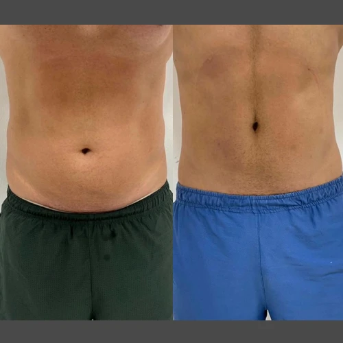 Antes e depois Slim Lipodetox® 3