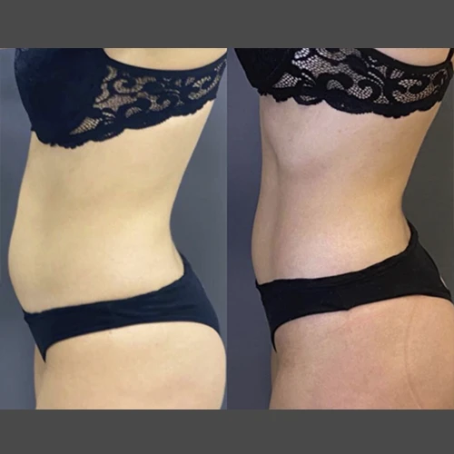 Antes e depois Slim Lipodetox® 4