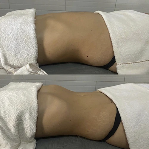Antes e depois Slim Lipodetox® 5