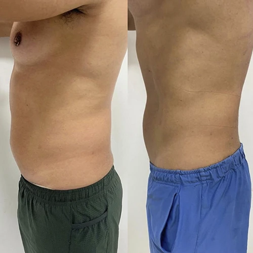 Antes e depois Slim Lipodetox® 6
