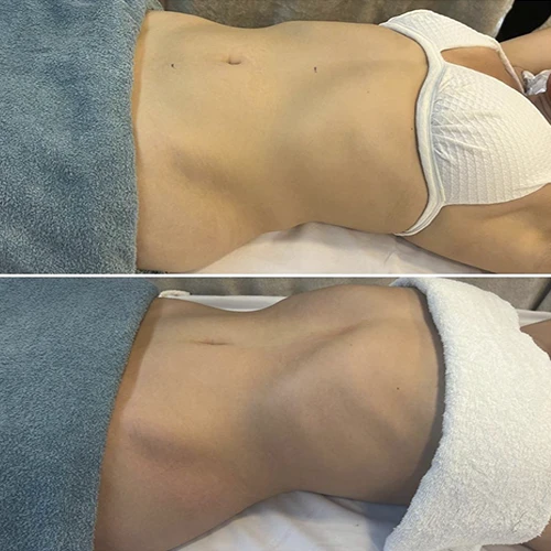 Antes e depois Slim Lipodetox® 7